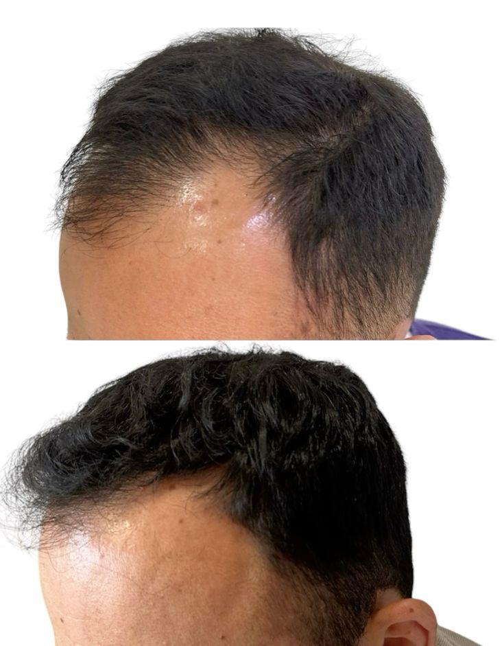 Mohammed R. — male hair restoration result after 5 PRP sessions