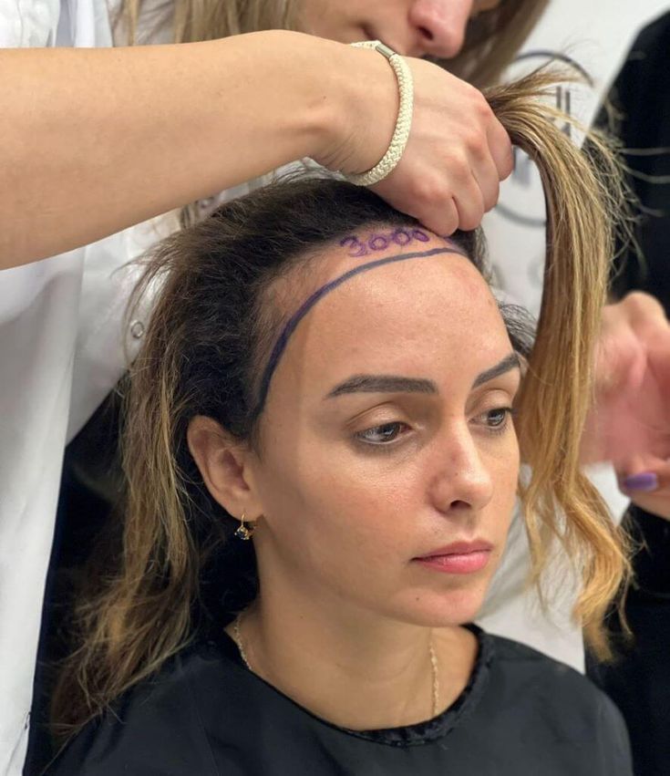 Hair restoration — hairline preparation at HC Medical