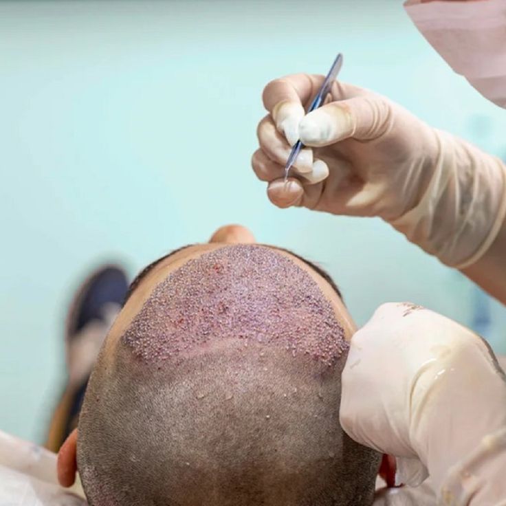 Hair transplant procedure close-up at HC Medical